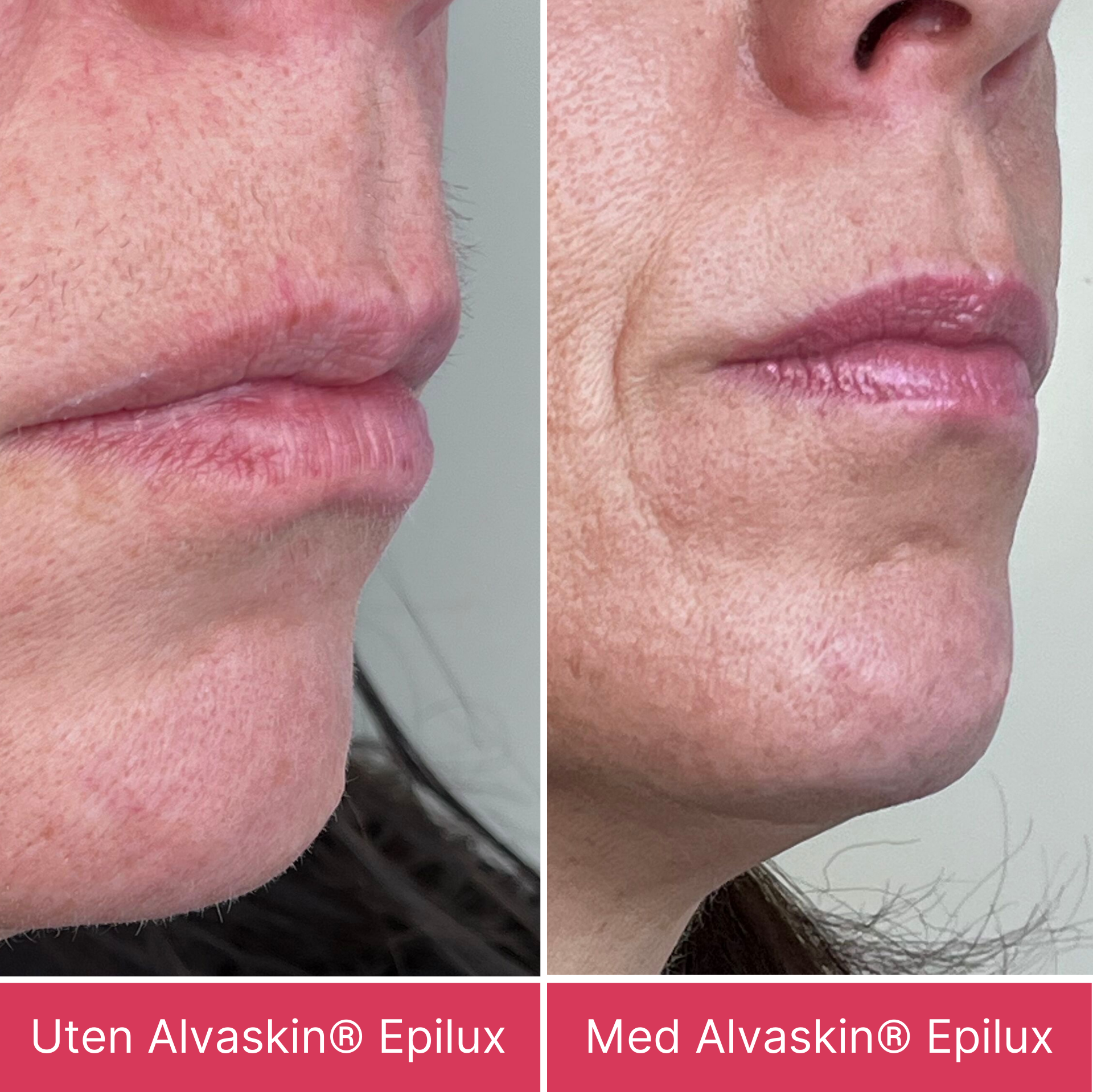 Alvaskin® Epilux