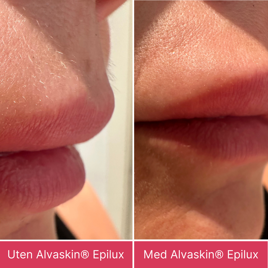 Alvaskin® Epilux